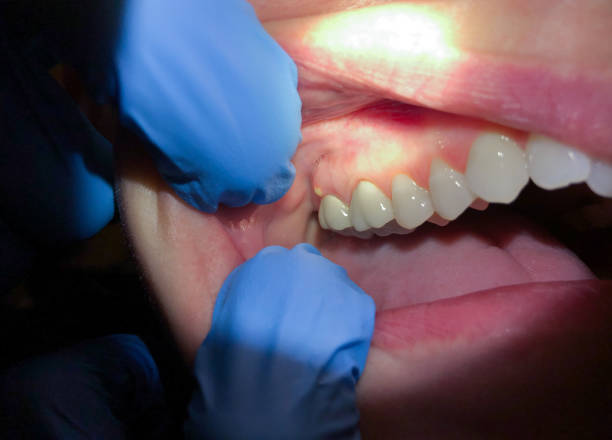 Best Emergency Tooth Extraction in Walkertown, NC